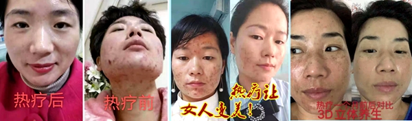 睡热疗美容效果003.jpg