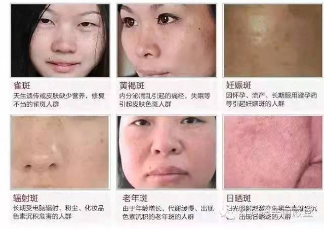 斑与妇科的关系